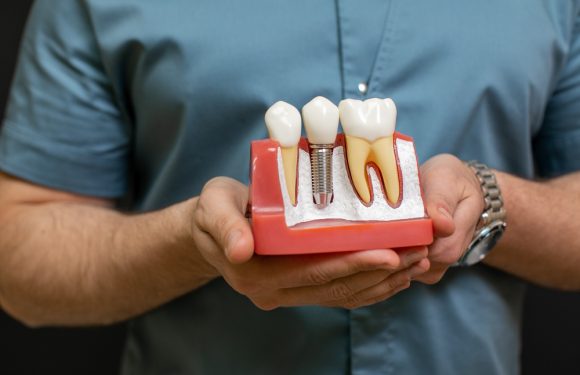 I benefici dell’implantologia dentale: perché scegliere gli impianti dentali