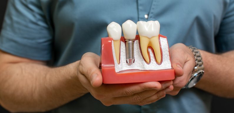 I benefici dell’implantologia dentale: perché scegliere gli impianti dentali