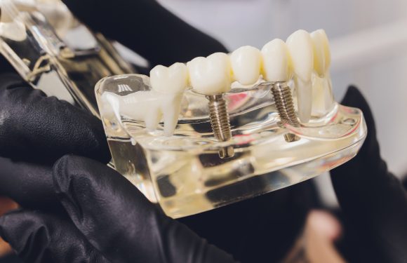 Riportare il sorriso con l’implantologia dentale a Bisceglie