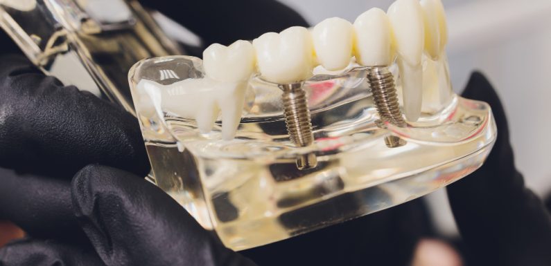 Riportare il sorriso con l’implantologia dentale a Bisceglie